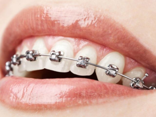 I vantaggi di applicare un apparecchio ai denti